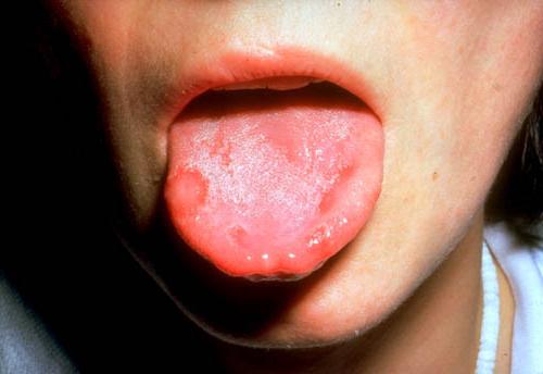 소아에서의 구내염 : 증상 및 치료