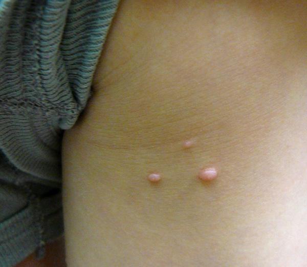 바이러스 성 molluscum contagiosum : 그것은 무엇입니까?