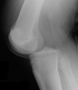 무릎 관절 탈구 : 기본 증상, 치료
